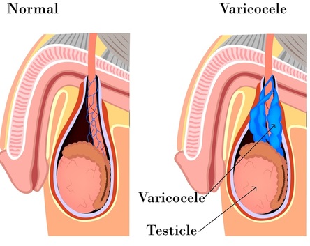 Varicocele & Varicocele Treatment