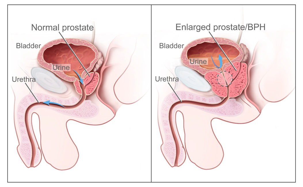 varicocele prostate bladder