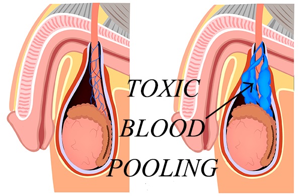 Varicocele: Toxic Blood Pooling