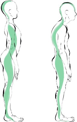 varicocele posture weight lifting