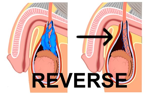 reverse varicocele