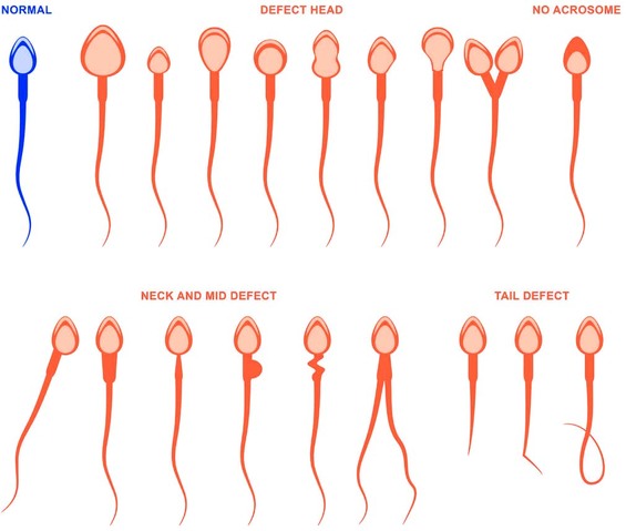 sperm defects vs healthy sperm
