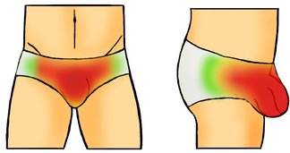 Varicocele pain caused by underwear